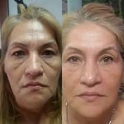 Tratamiento ansiedad con HIFU
